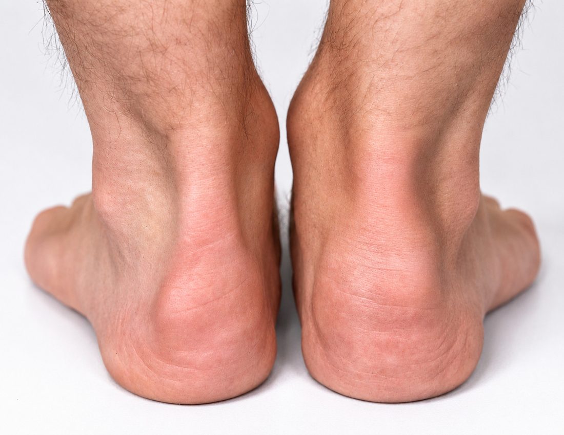 Swelling at the back of both heels where the Achilles tendon attaches to bone.