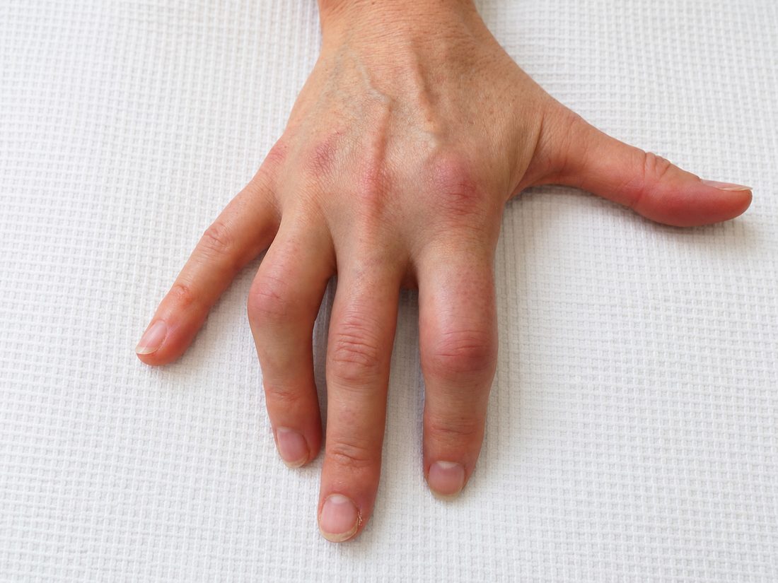 A finger swollen along its whole length, known as dactylitis or a sausage digit.