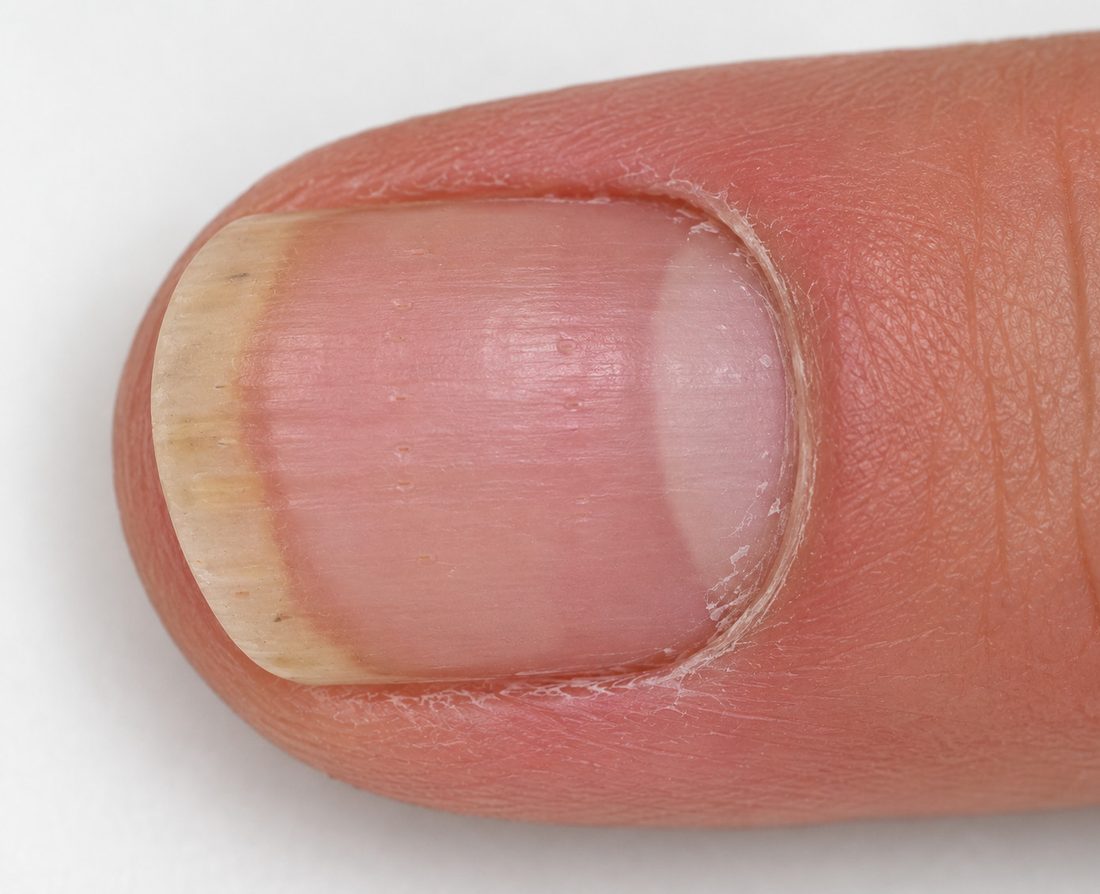 A fingernail showing changes seen in psoriatic nail disease.